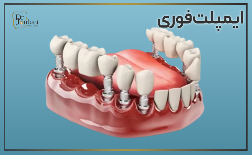 ایمپلنت فوری